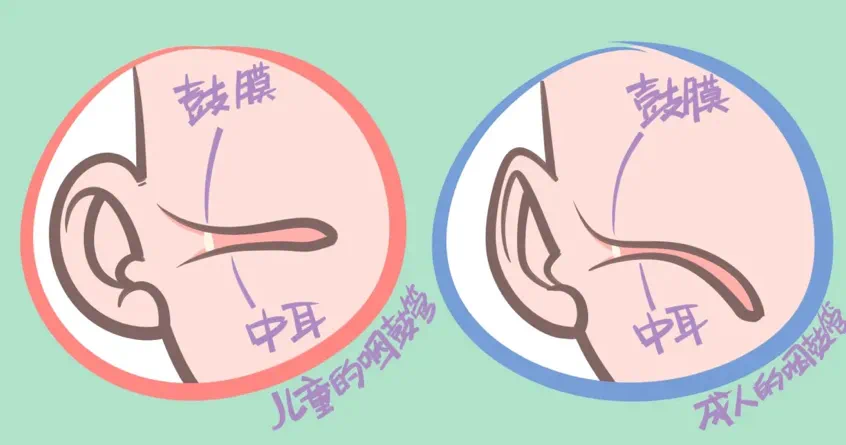 儿童中耳炎1.png
