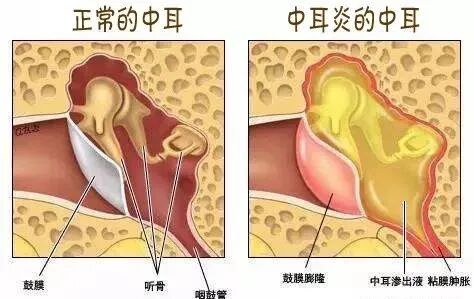 儿童中耳炎2.jpg
